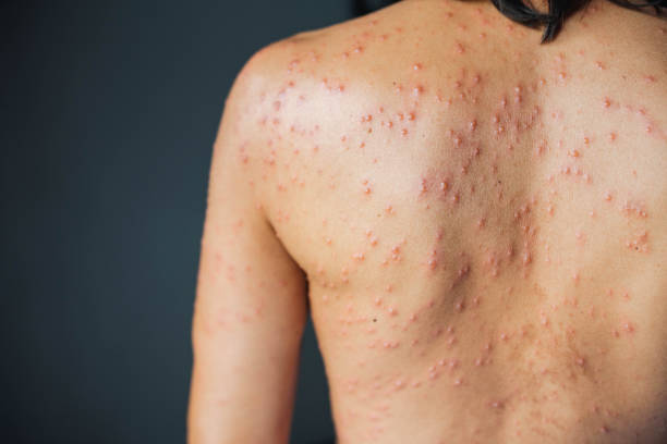 Effective Strategies for Getting Rid of Back Pimples: A Comprehensive Guide